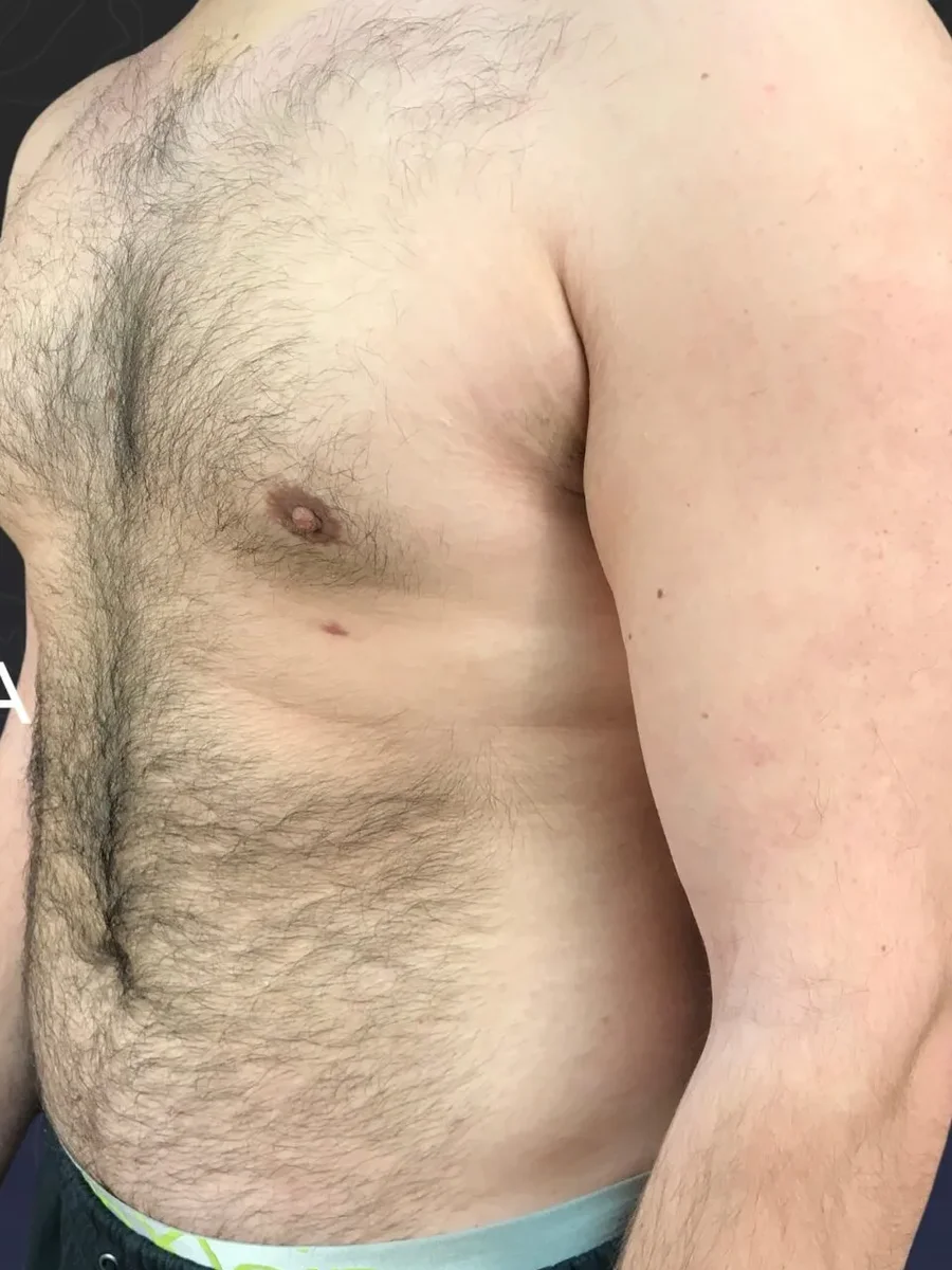 Gynecomastia after, 25-year-old patient
