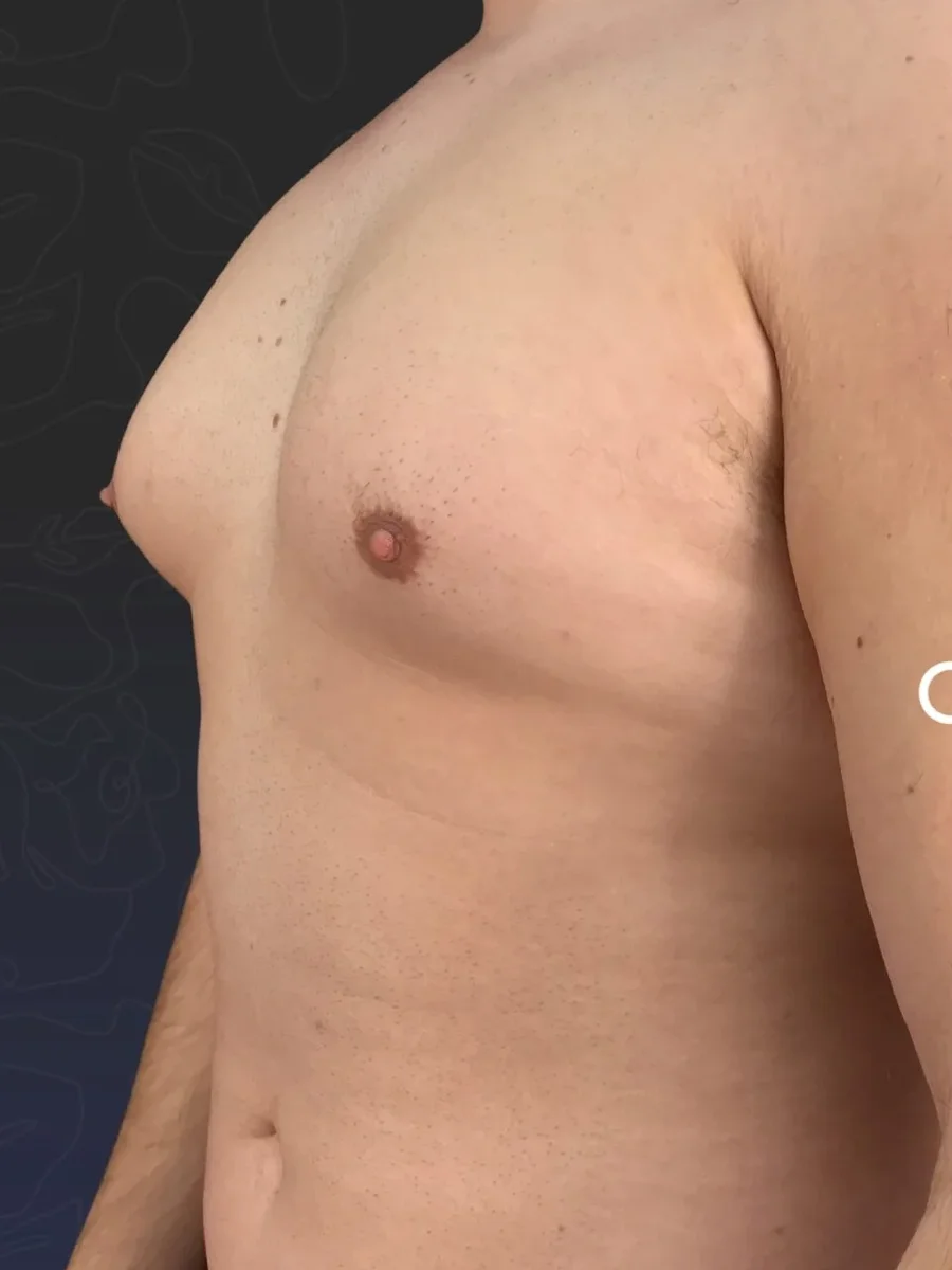Gynecomastia before, 25-year-old patient