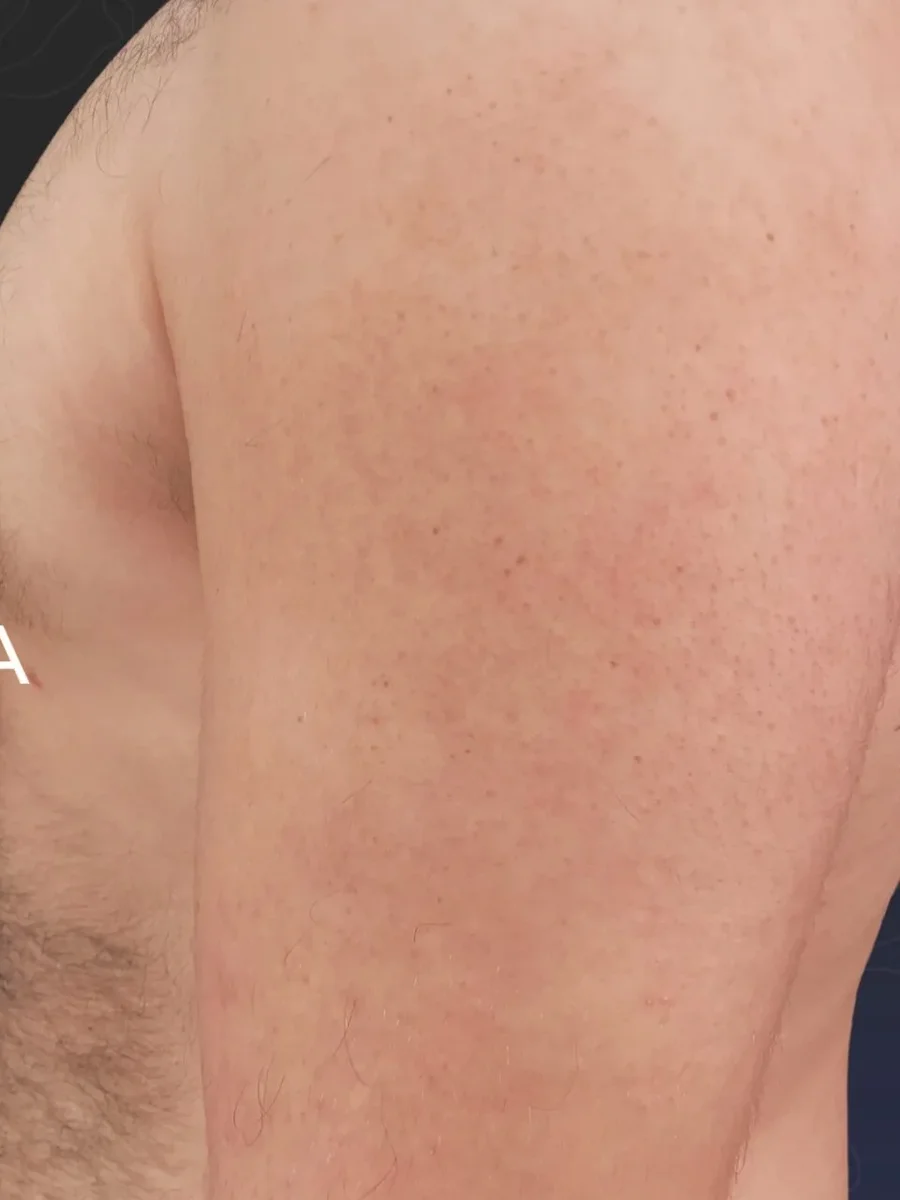 Gynecomastia after, side view