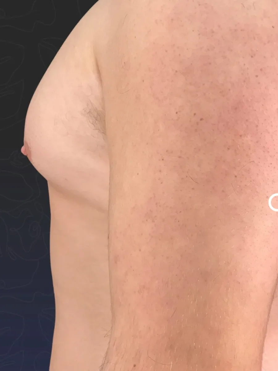 Gynecomastia before, side view