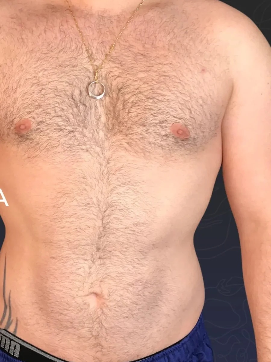 Gynecomastia after, 32-year-old patient