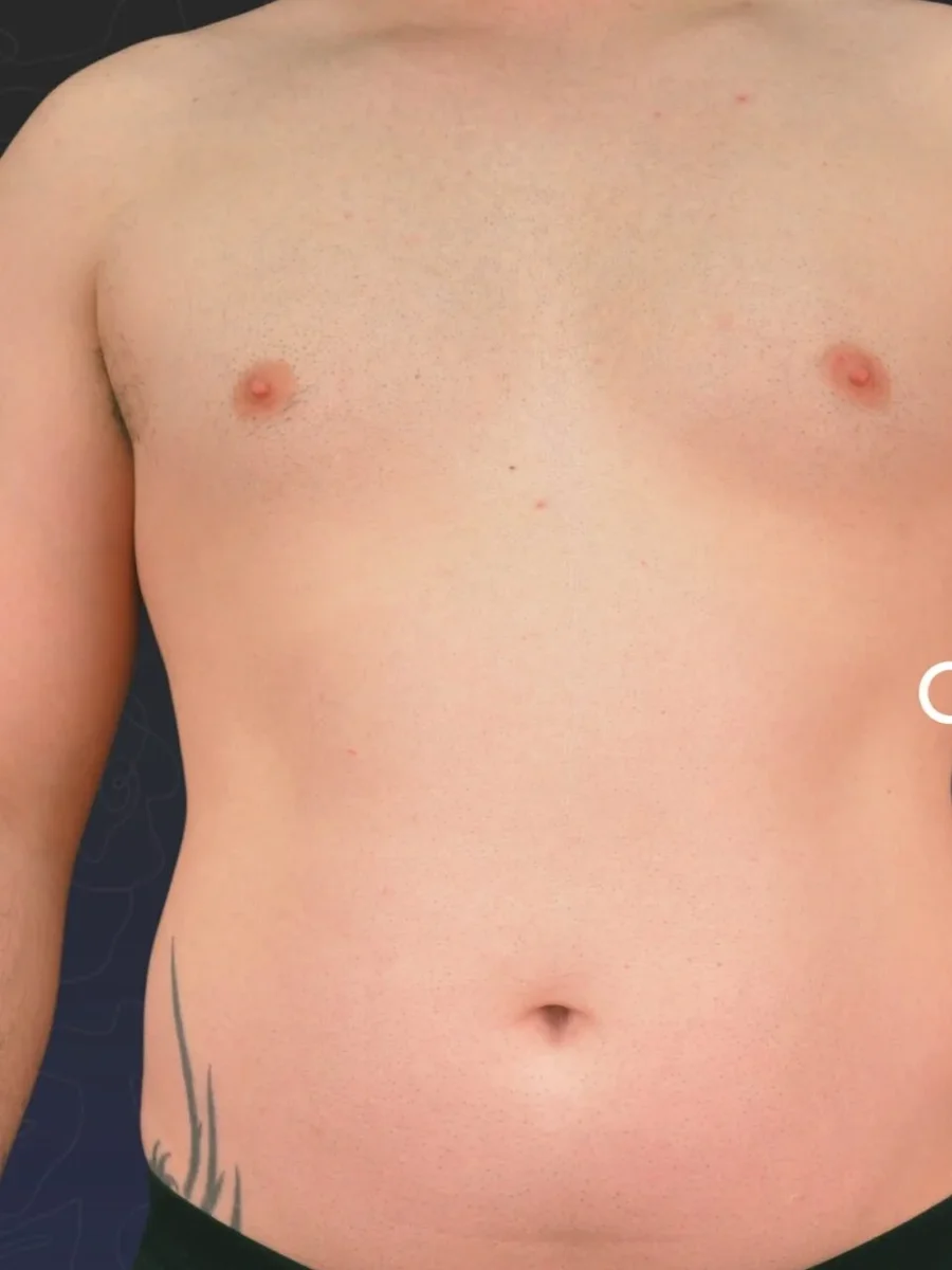 Gynecomastia before, 32-year-old patient