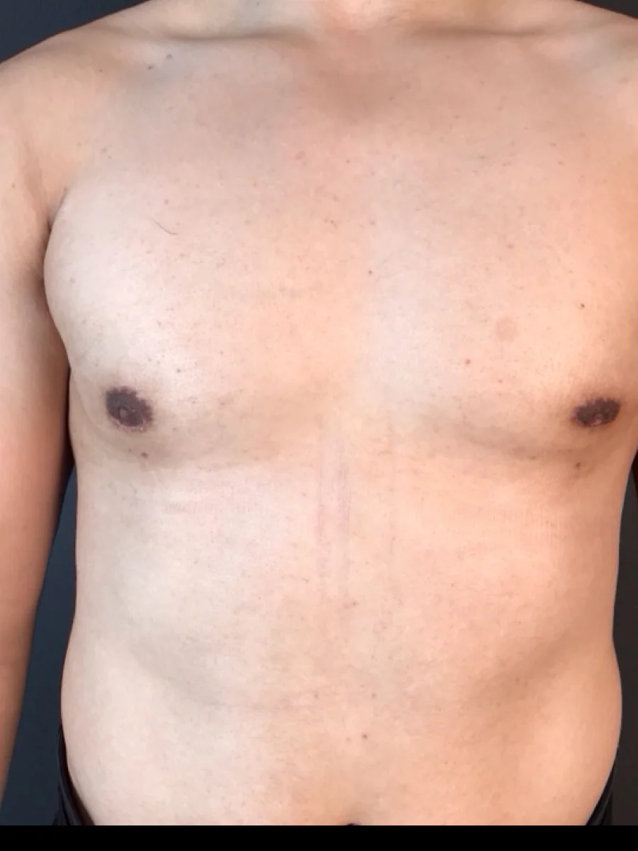 Gynecomastia after