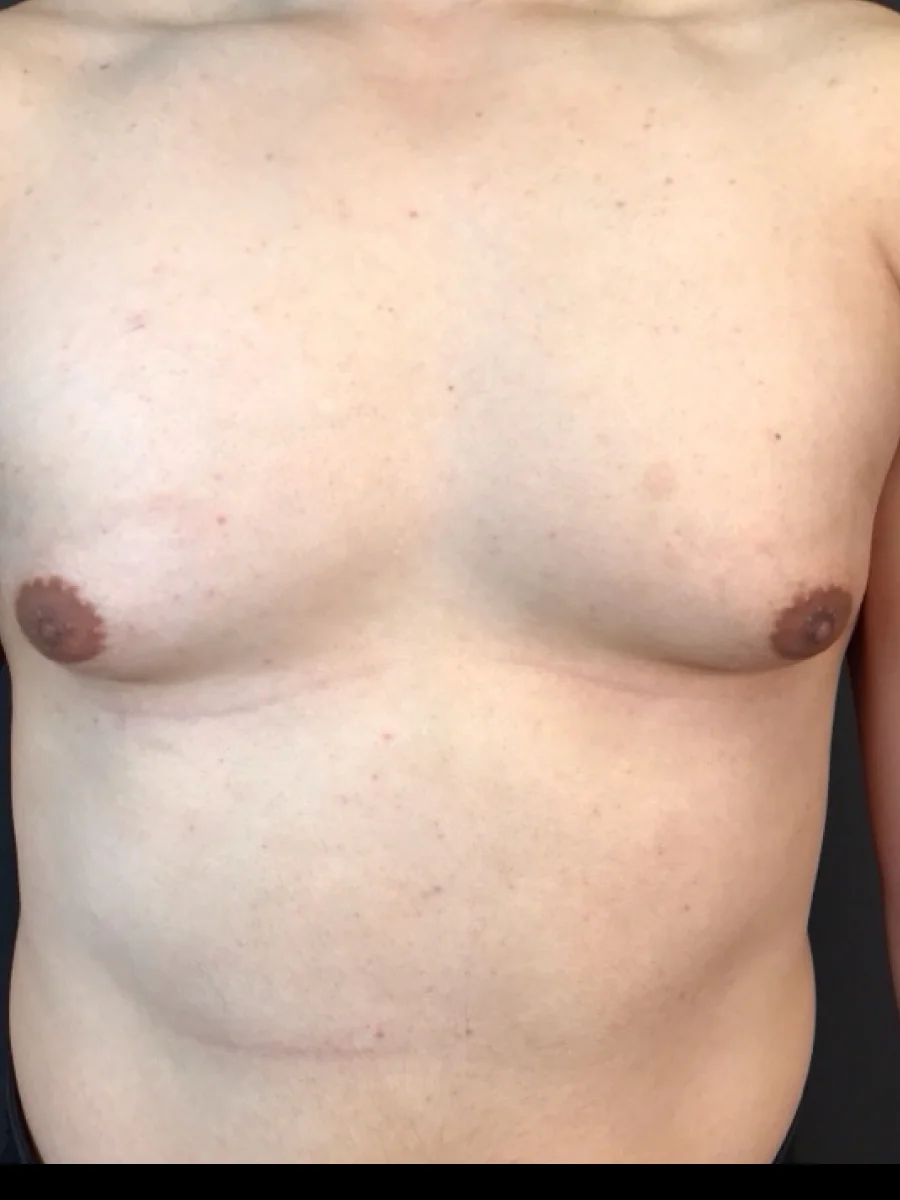 Gynecomastia before