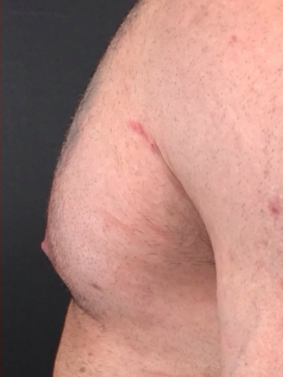 Gynecomastia after, close side view