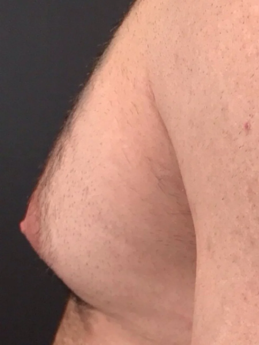 Gynecomastia before, close side view