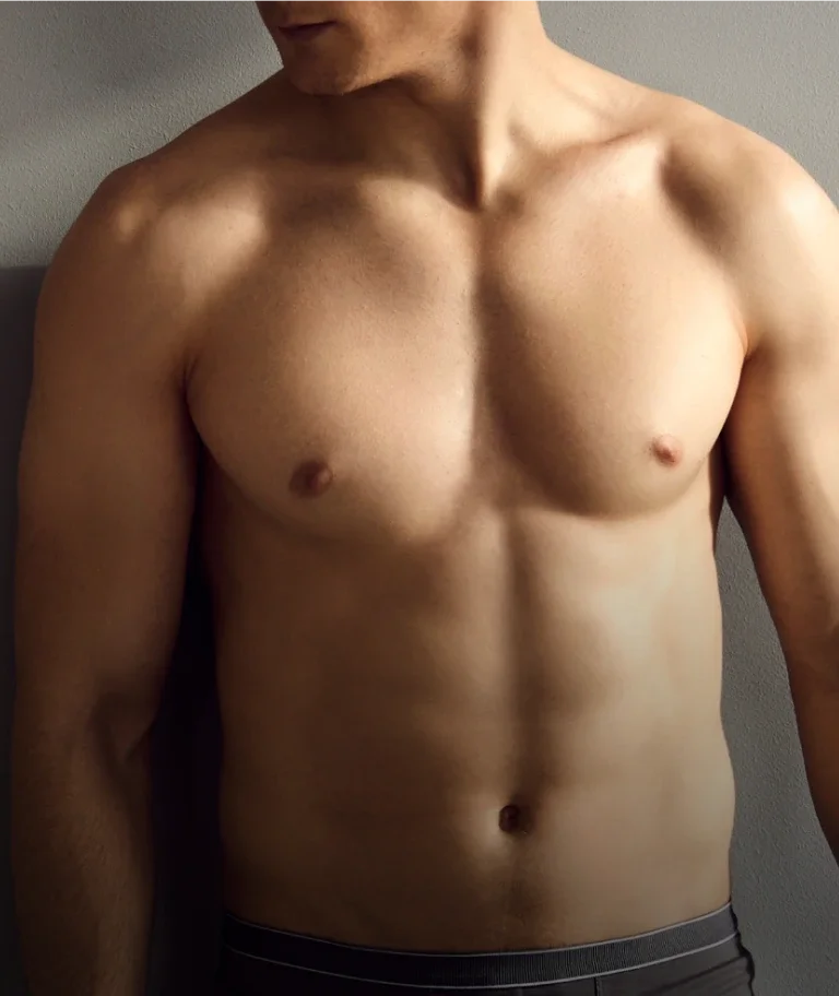 Male chest after gynecomastia contouring