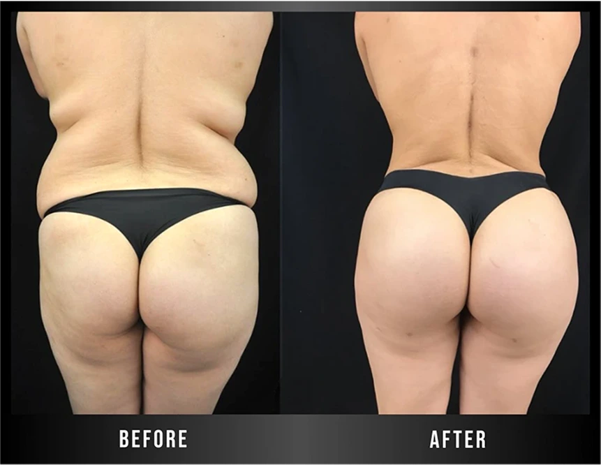 Best Liposuction Banner