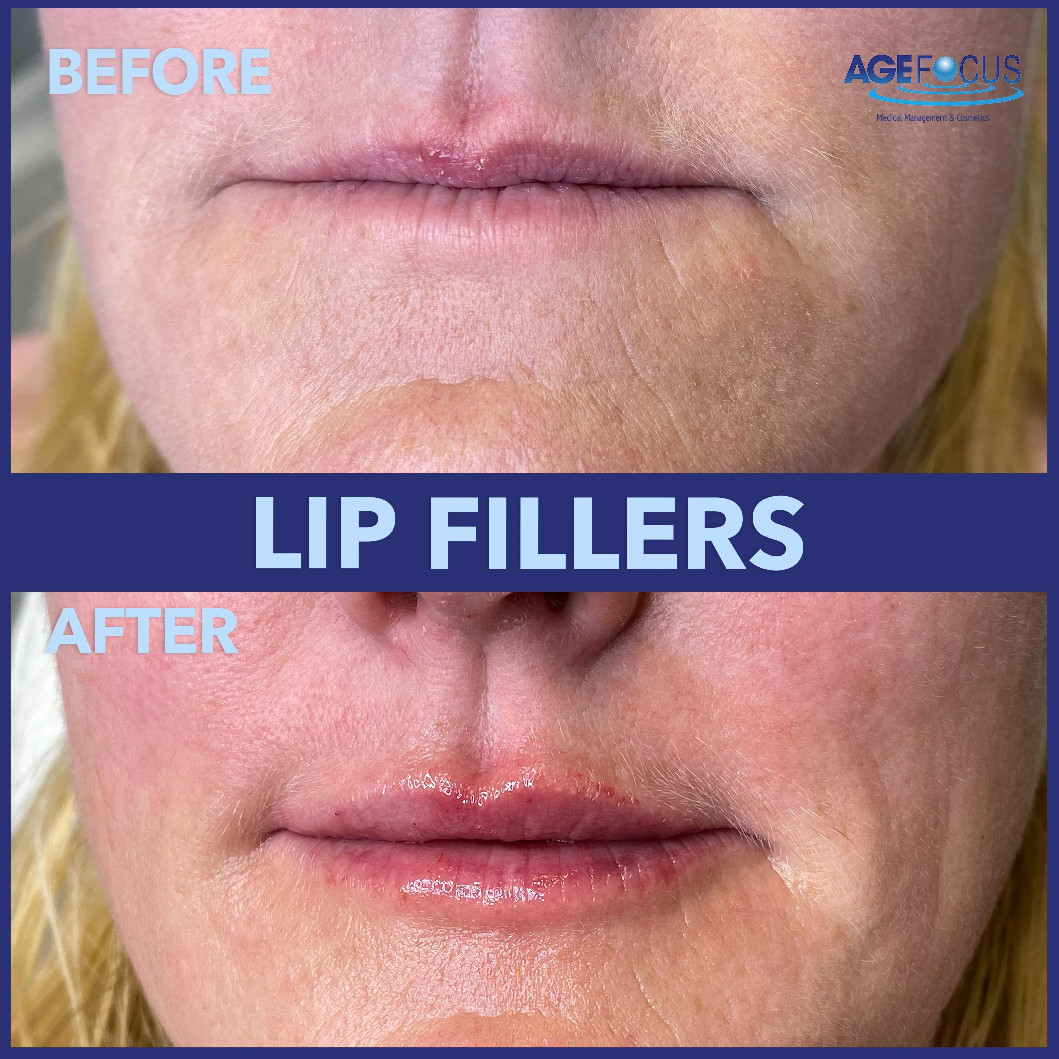 LIP FILLERS B&A