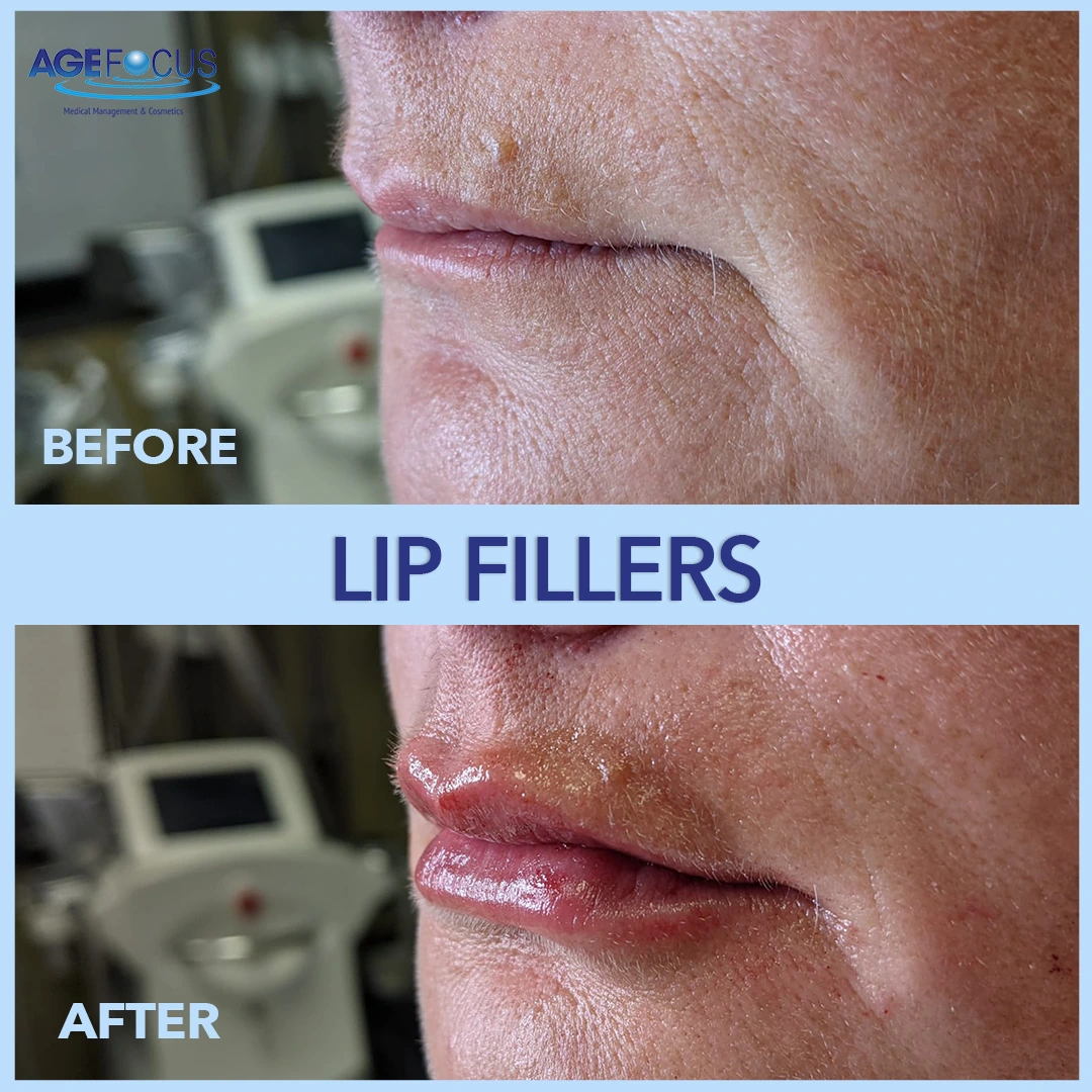 LIP FILLERS2