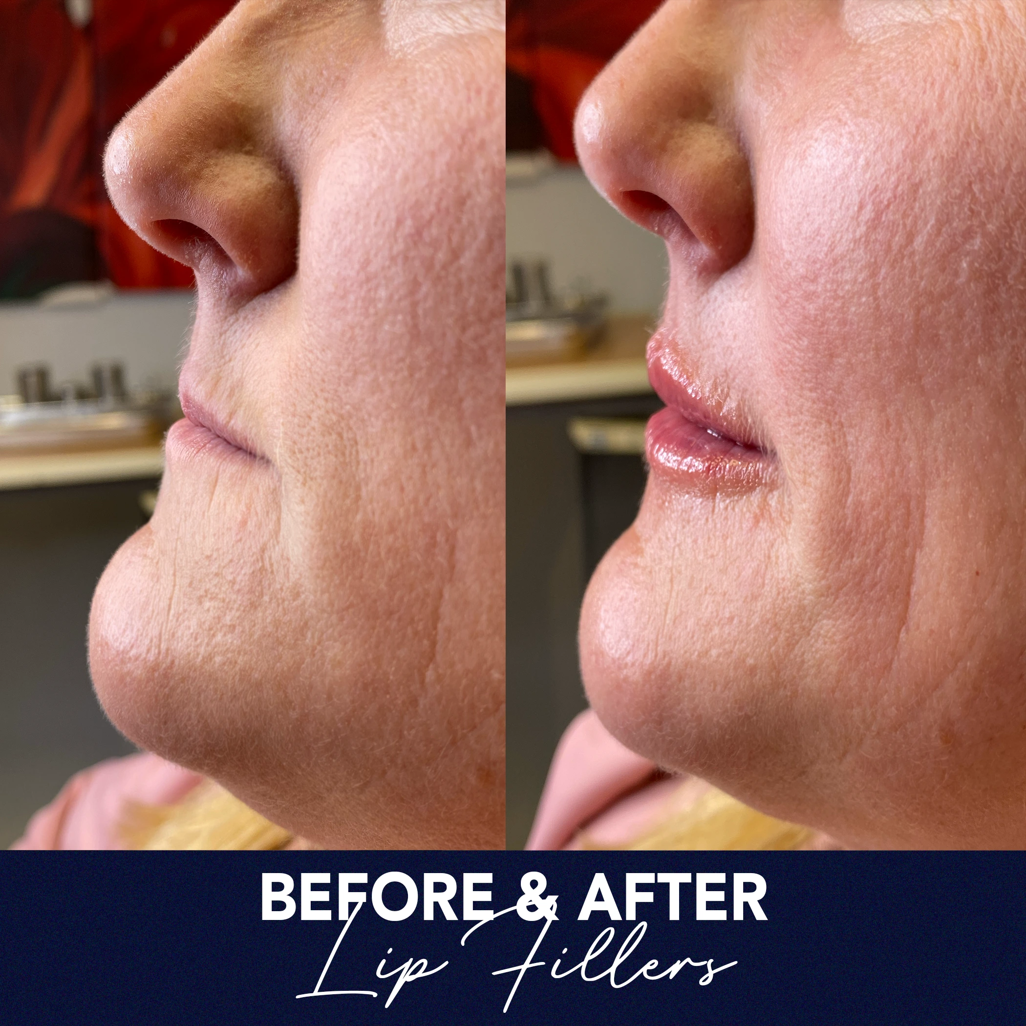 fillers vertical b&a 2