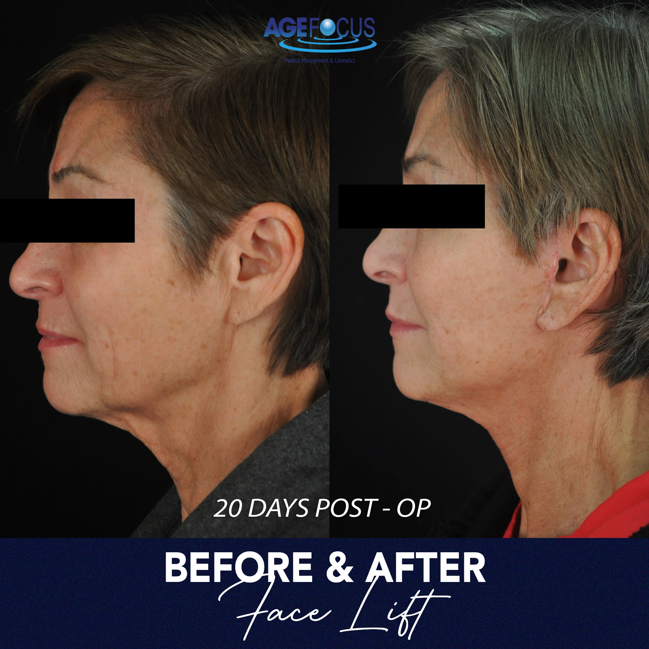 julie face lift 2